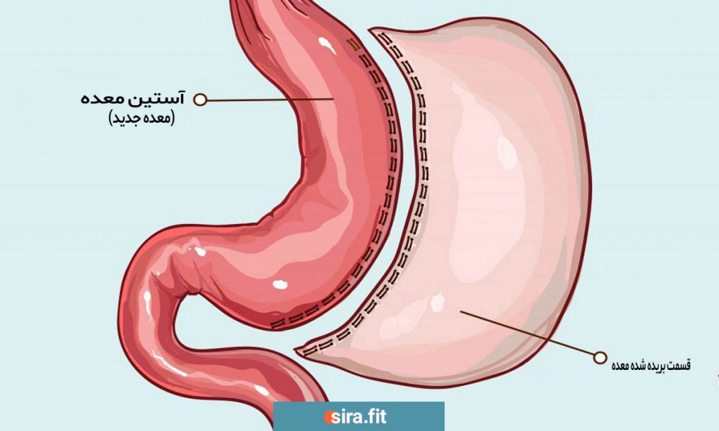 عمل اسلیو معده