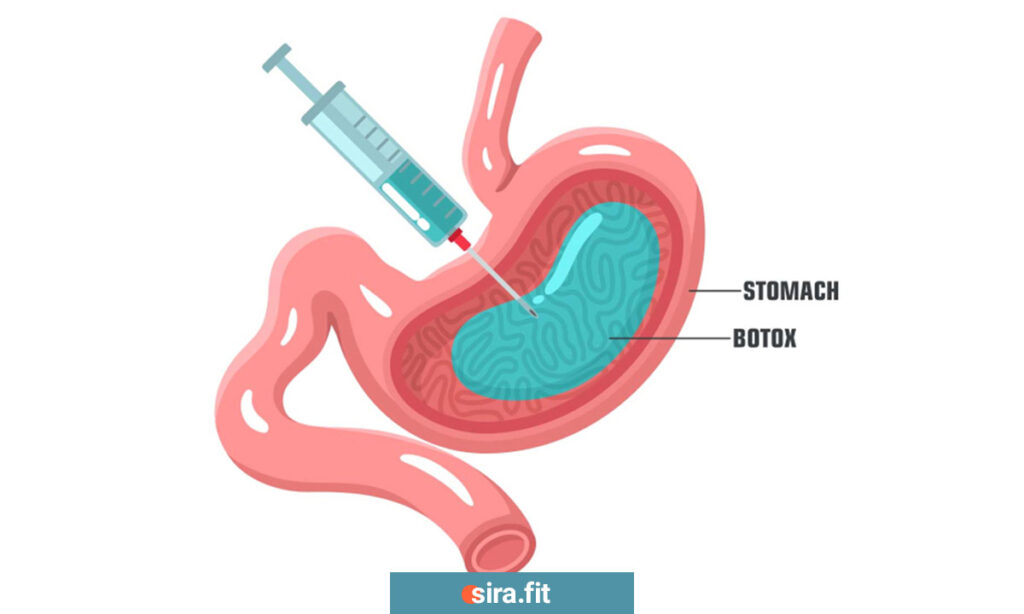 تزریق بوتاکس معده